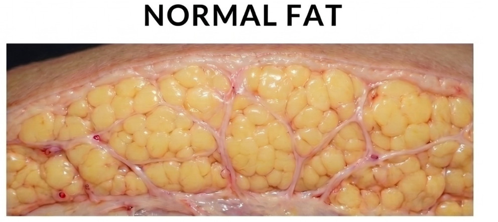 Normal fat