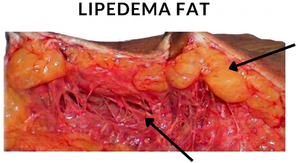 Lipedema fat